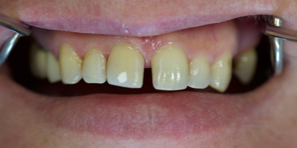 Неудовлетворенность реставрацией на переднем центральном зубе - фото №2