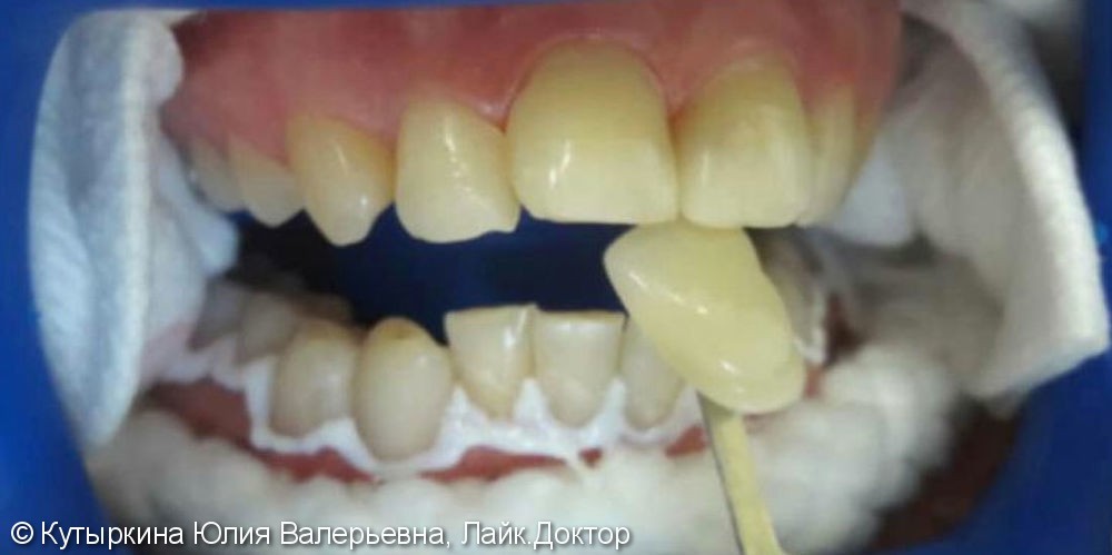 Отбеливание зубов системой Zoom произведено за 1 посещение, до и после - фото №1