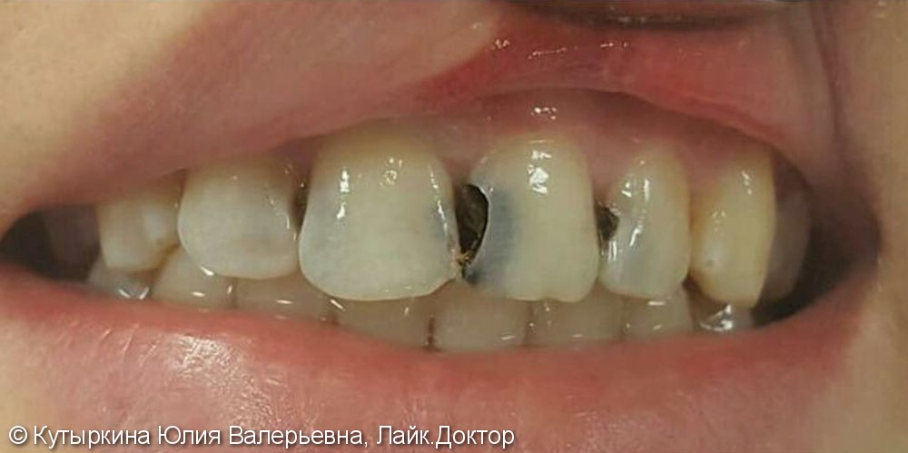 Лечение зубов в зоне улыбки, до и после - фото №1