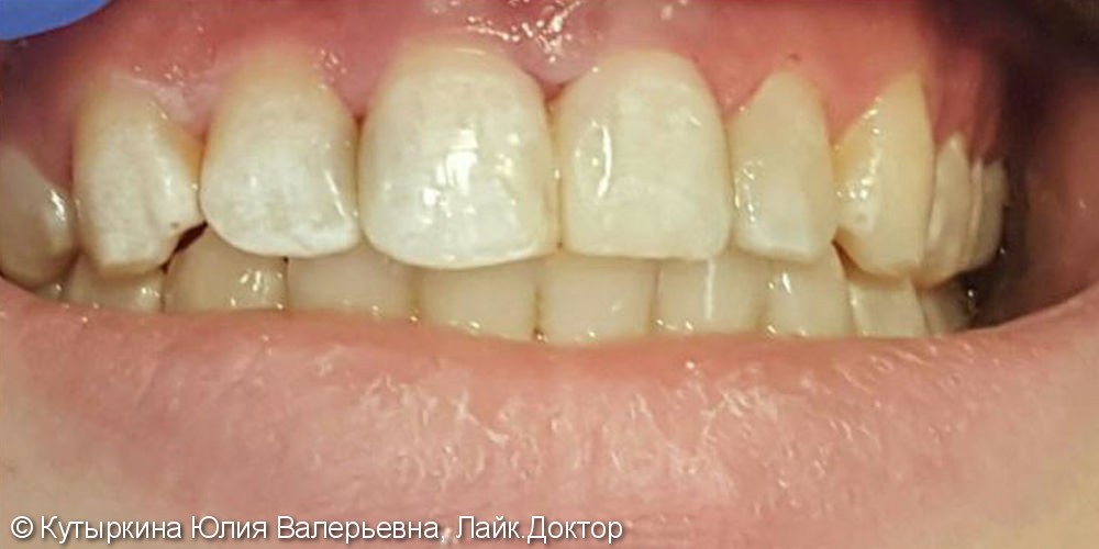 Лечение зубов в зоне улыбки, до и после - фото №2