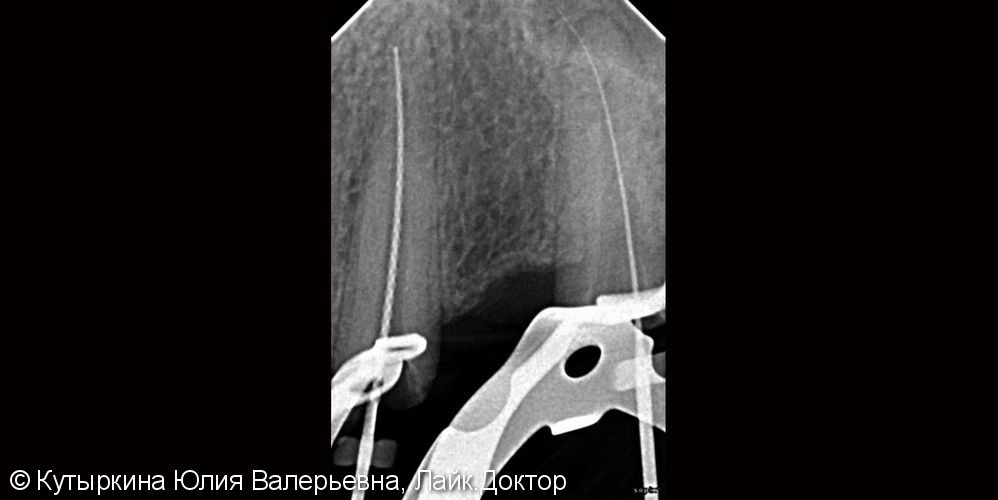 Извлечение сломанного инструмента и последующее лечение - фото №3