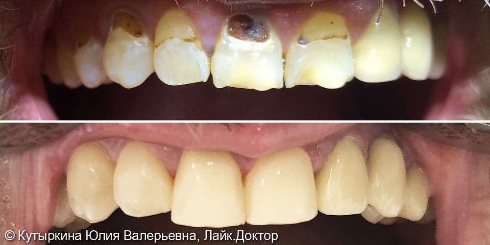 Реставрация фронтальной группы зубов. Восстановление зубов фотокомпозитным материалом - фото №1