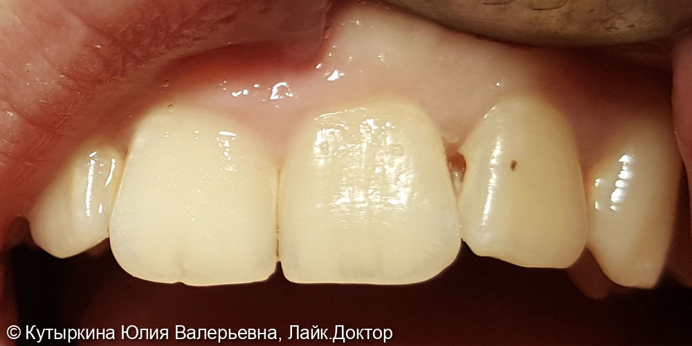 Лечение кариеса и восстановление зуба 2.2 - фото №1