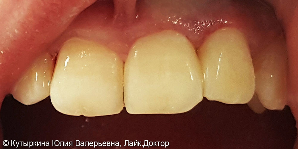 Лечение кариеса и восстановление зуба 2.2 - фото №2