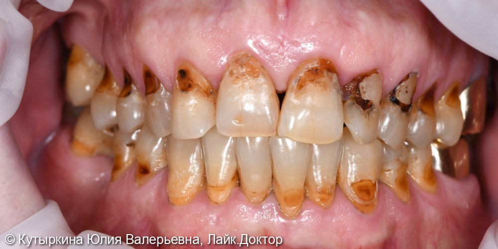 Лечение передних зубов верхней челюсти - фото №1
