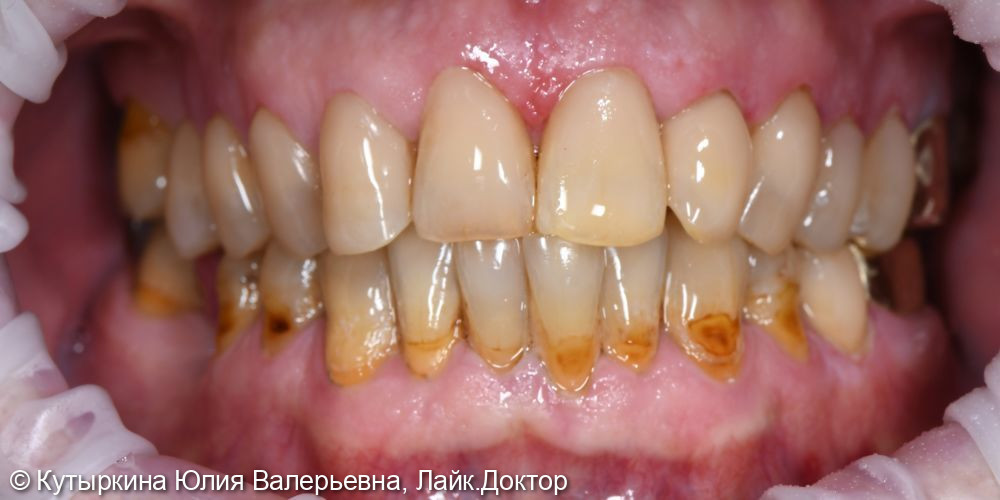 Лечение передних зубов верхней челюсти - фото №2