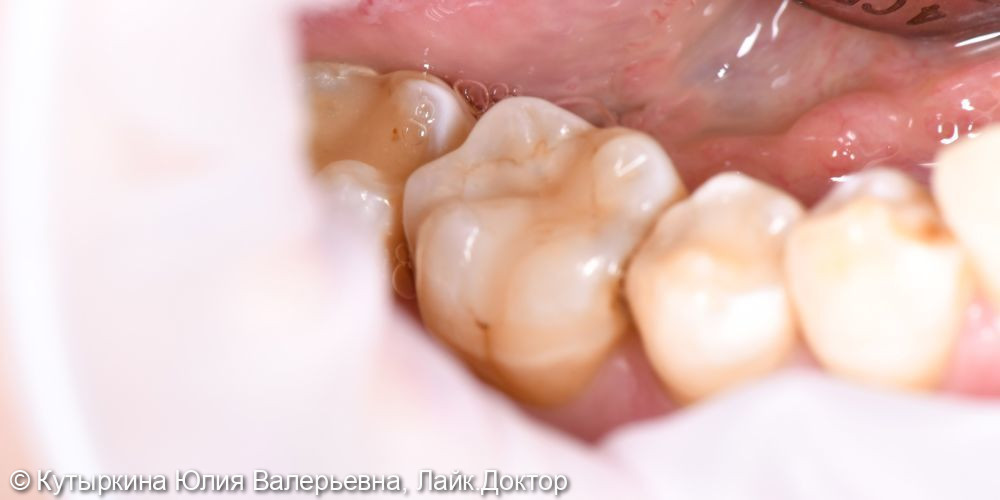 Лечение кариеса 46 зуба - фото №1