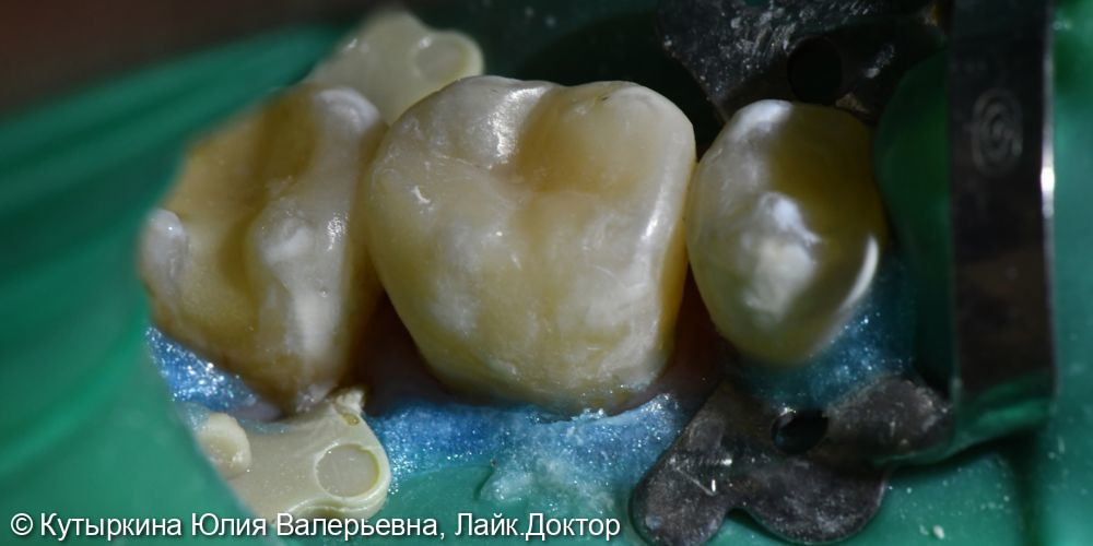 Лечение кариеса 46 зуба - фото №4