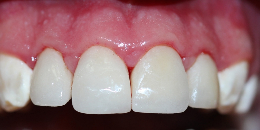 Реставрация керамическими винирами передних зубов - фото №2