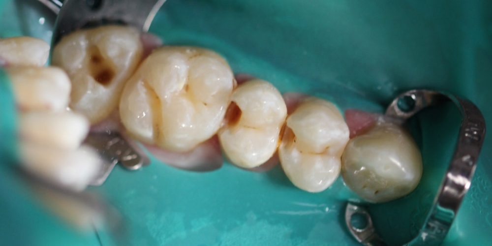 Результат лечения кариеса четырех зубов за один прием - фото №1