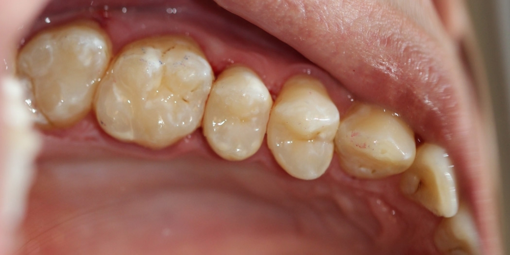 Результат лечения кариеса четырех зубов за один прием - фото №3
