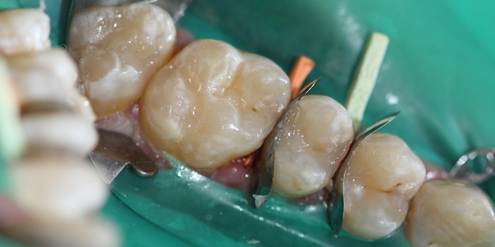 Результат лечения кариеса четырех зубов за один прием - фото №2