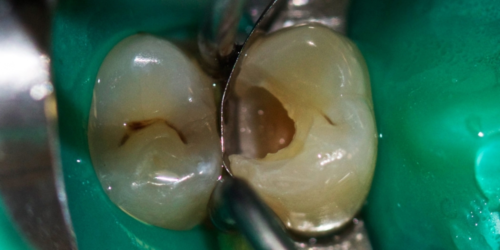 Лечение зуба под анастезией с применением коффердама - фото №1