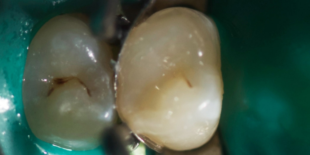 Лечение зуба под анастезией с применением коффердама - фото №2