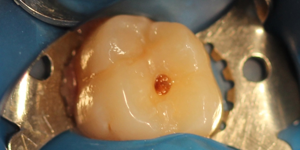 Лечение кариеса жевательного зуба материалом Харизма, Германия - фото №1