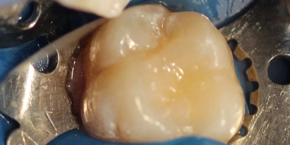 Лечение кариеса жевательного зуба материалом Харизма, Германия - фото №2