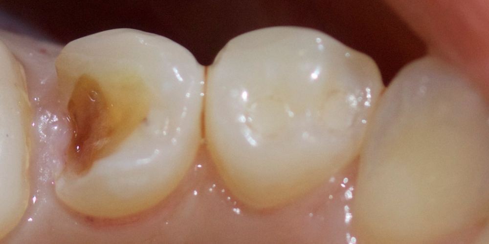 Результат лечения сколовшегося зуба - фото №1