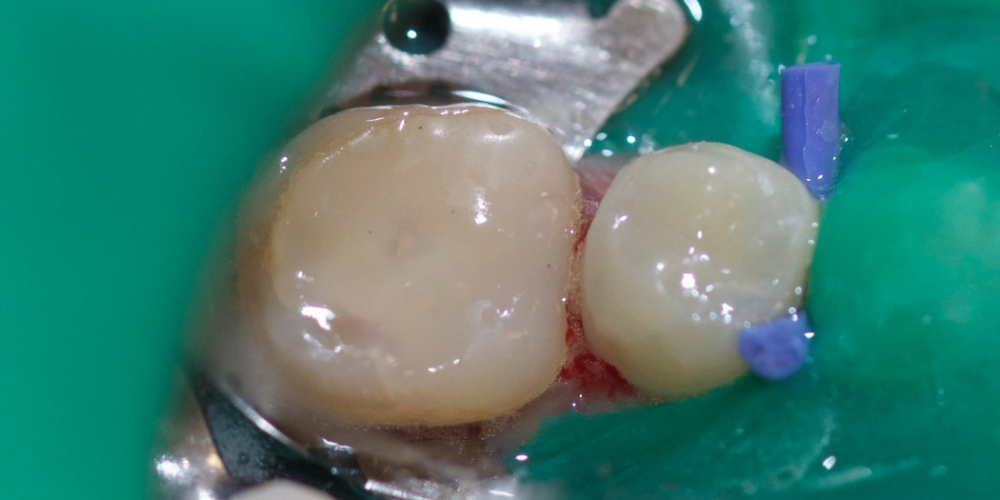 Результат лечения сколовшегося зуба - фото №3