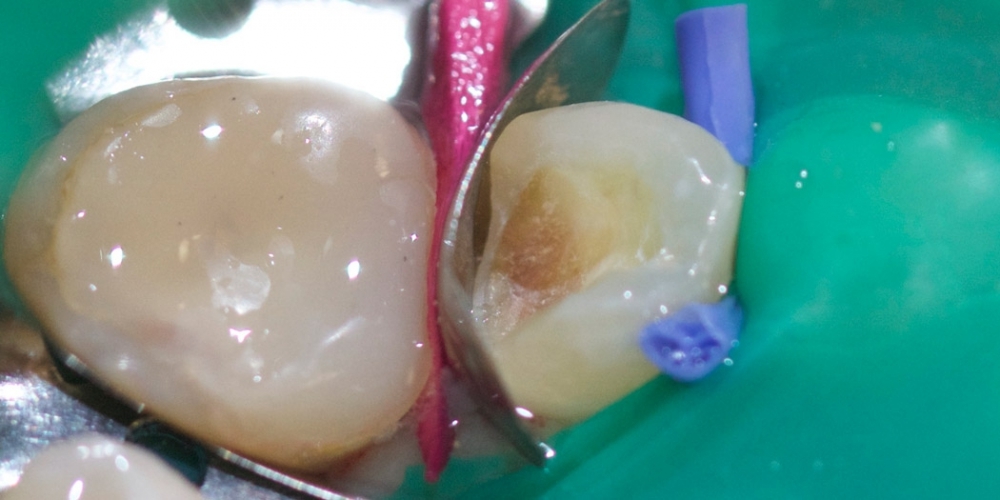 Результат лечения сколовшегося зуба - фото №2