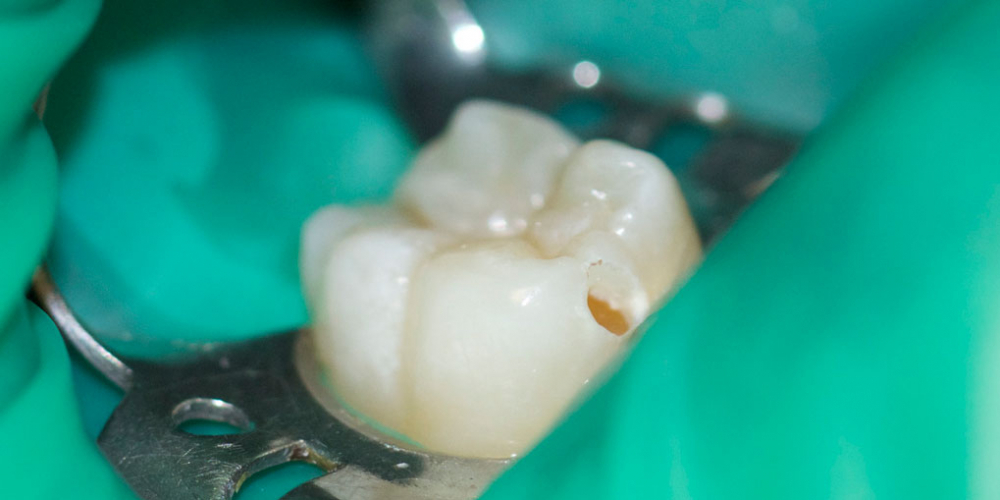 Лечение кариозного процесса на жевательном зубе нижней челюсти - фото №1