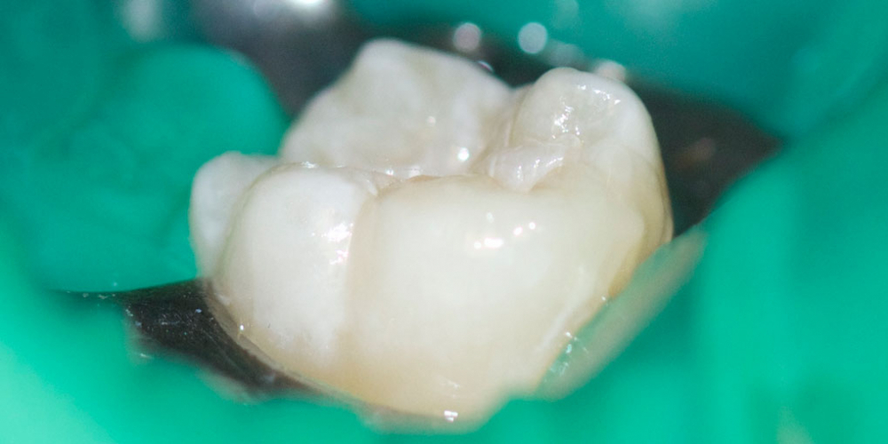 Лечение кариозного процесса на жевательном зубе нижней челюсти - фото №2