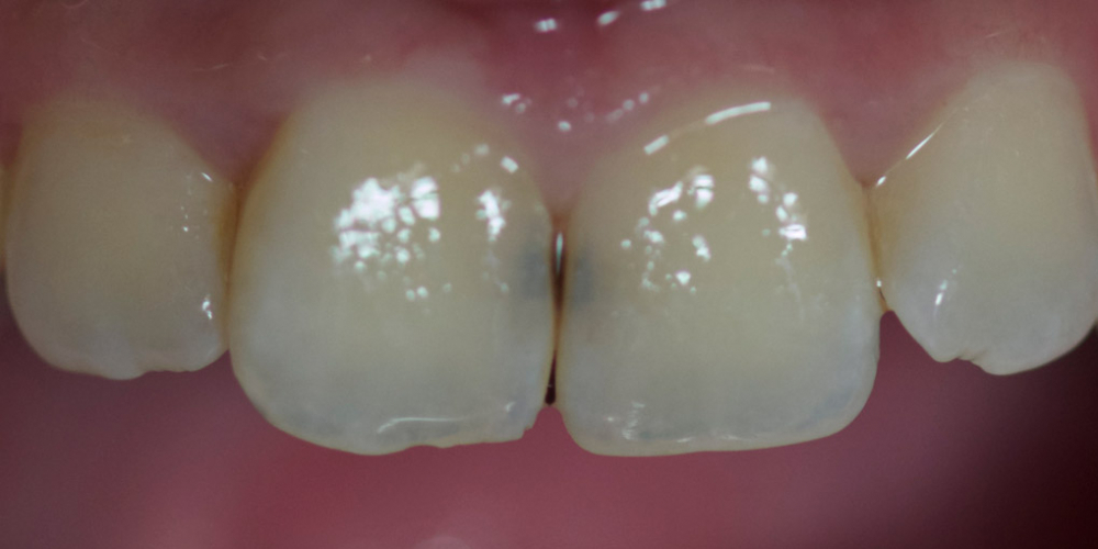 Лечение зубов и эстетическая реставрация, реакция на холод - фото №1