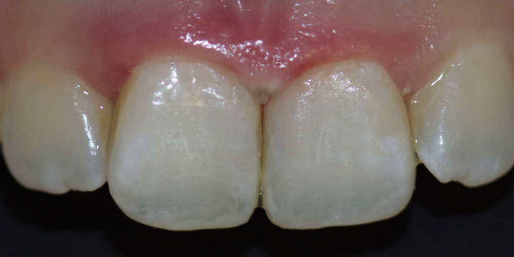 Лечение зубов и эстетическая реставрация, реакция на холод - фото №2