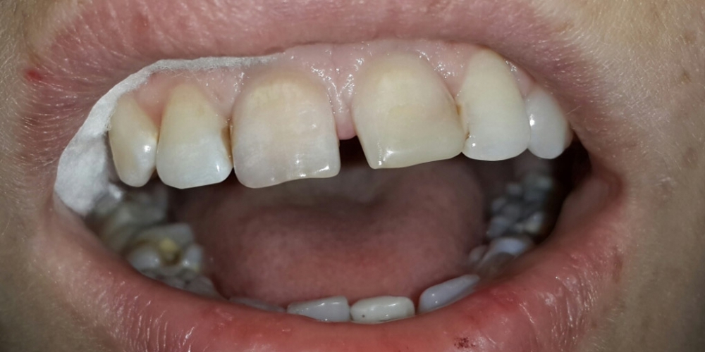 Внутриканальное отбеливание и реставрация передних зубов - фото №1
