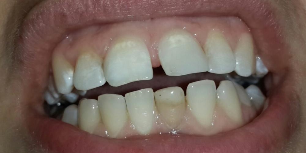 Внутриканальное отбеливание и реставрация передних зубов - фото №2