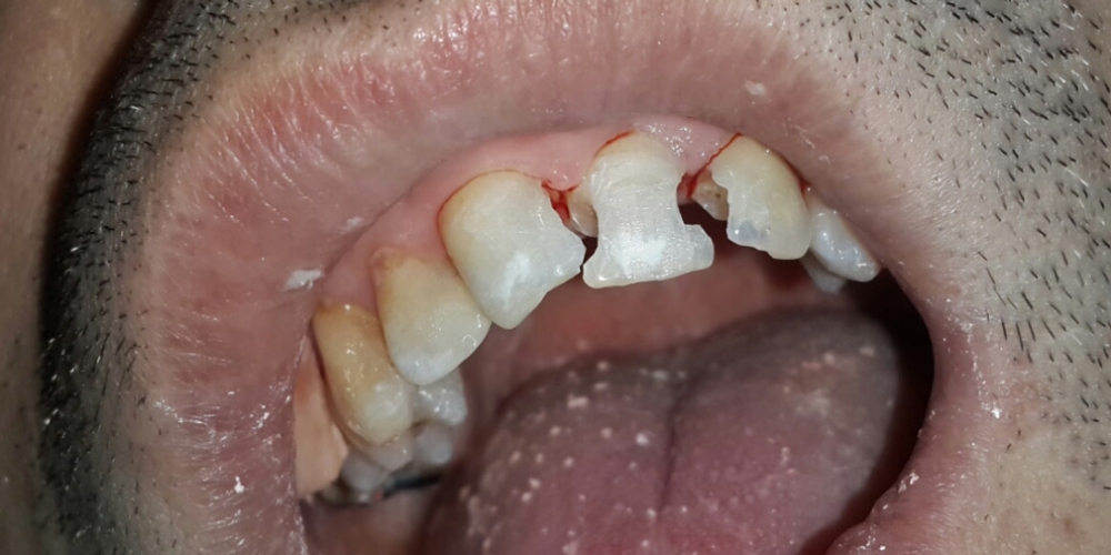 Результат восстановления передних зубов - фото №1