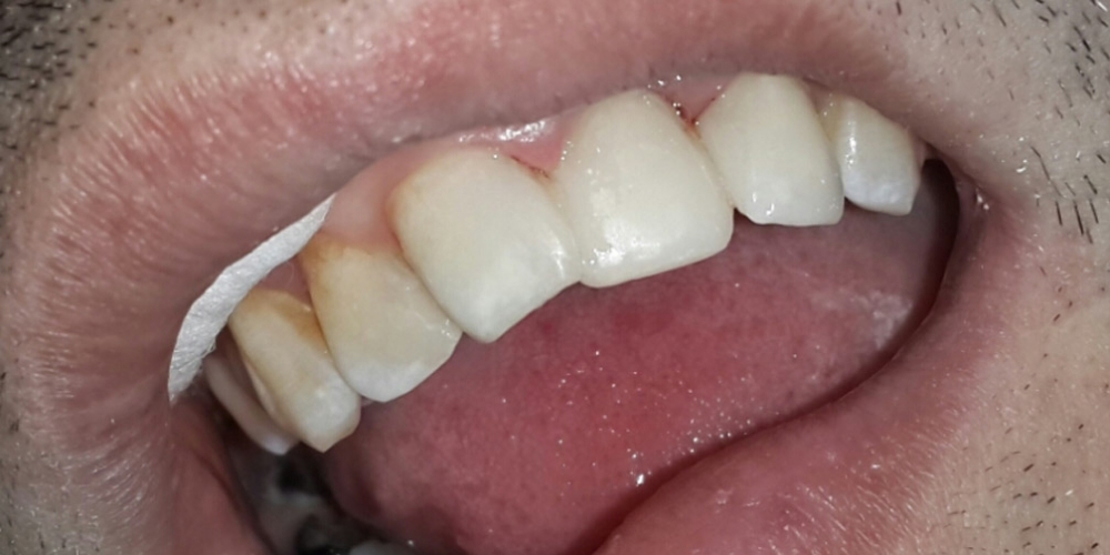 Результат восстановления передних зубов - фото №2