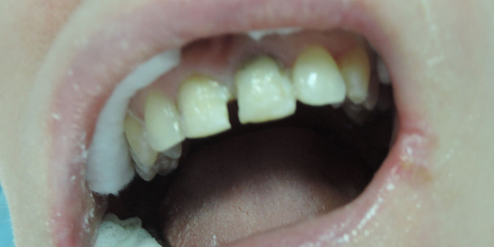 Реставрация 2 зубов светоотверждаемыми композитами - фото №1
