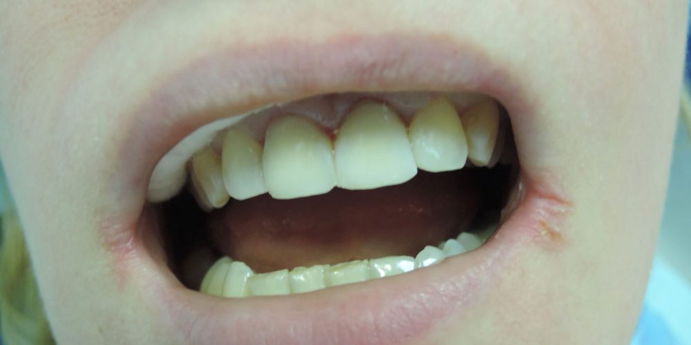 Реставрация 2 зубов светоотверждаемыми композитами - фото №2