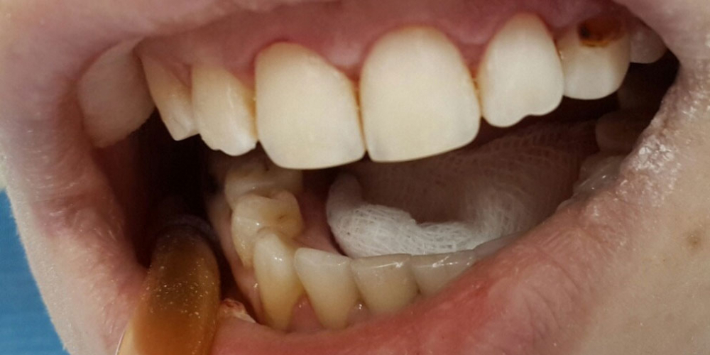 Лечение и художественная реставрация передних зубов - фото №3
