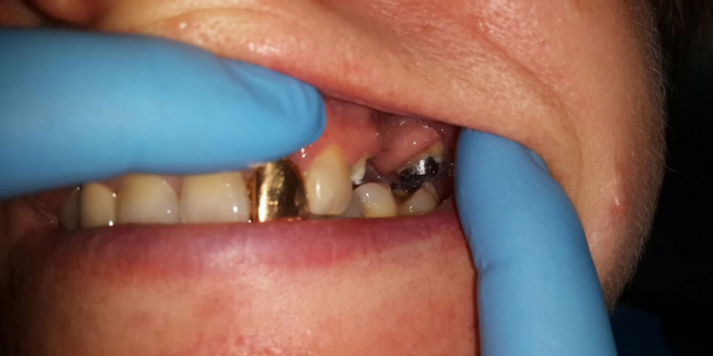 Мостовидный протез из металлокерамики, восстановление 2 зубов - фото №1