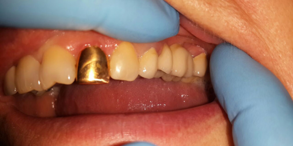 Мостовидный протез из металлокерамики, восстановление 2 зубов - фото №3