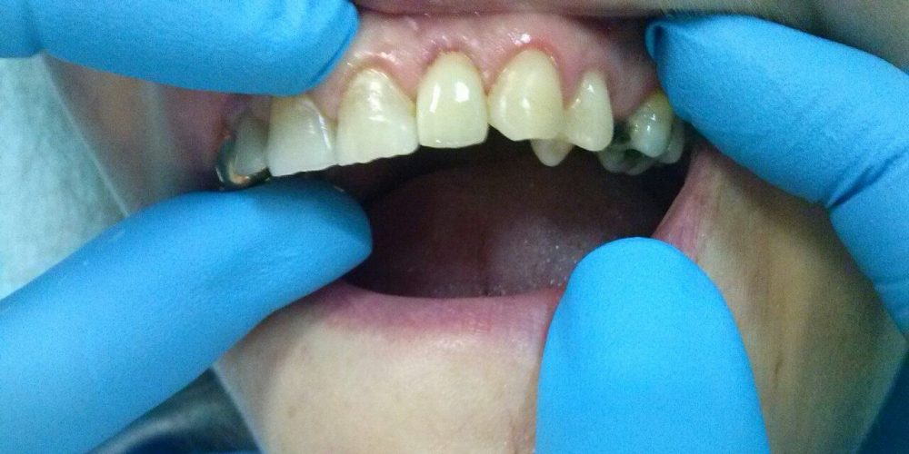 Протезирование зуба с помощью одиночной коронки из диоксида циркония Prettau - фото №2