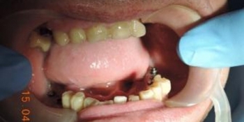 Имплантация зубов и последующее протезирование с применением диоксида циркония - фото №1