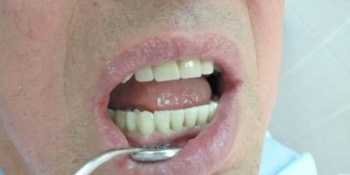Имплантация зубов и последующее протезирование с применением диоксида циркония - фото №2