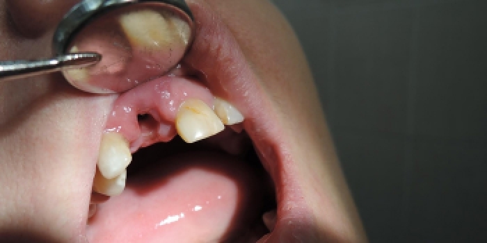 Одномоментная имплантация зубов с последующим протезированием, импланты MIS - фото №1