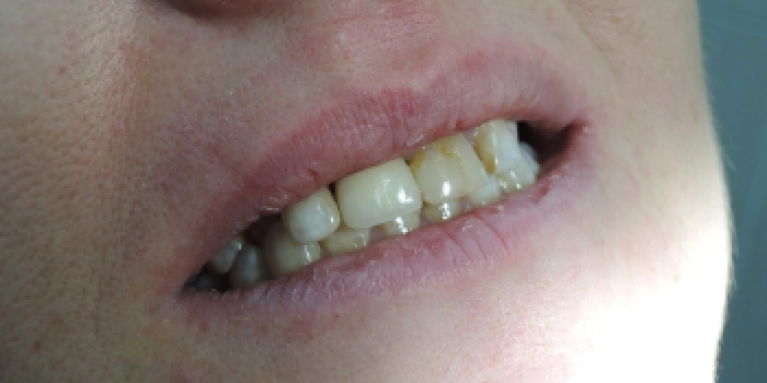 Одномоментная имплантация зубов с последующим протезированием, импланты MIS - фото №2