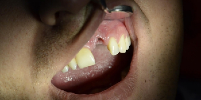 Одномоментная имплантация зубов по системе Astra-Tech с последующим протезированием - фото №1
