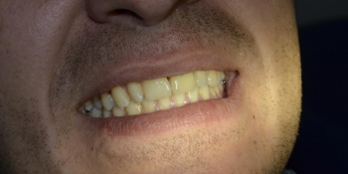 Одномоментная имплантация зубов по системе Astra-Tech с последующим протезированием - фото №2