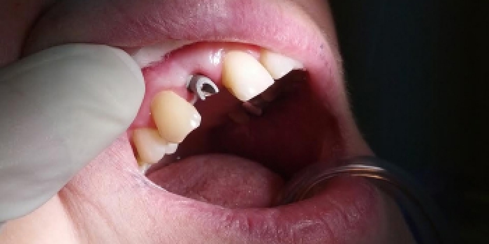 Имплантация зубов Конмет, коронка из металлокерамики - фото №1