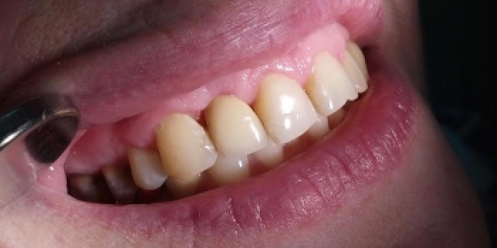 Имплантация зубов Конмет, коронка из металлокерамики - фото №2