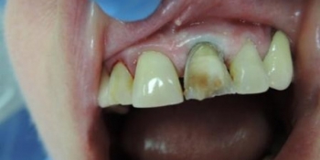 Реставрация зубов (виниры) - фото №1