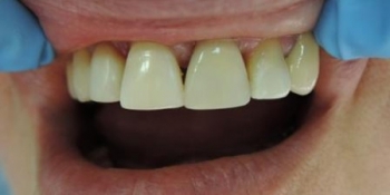 Реставрация зубов (виниры) - фото №2