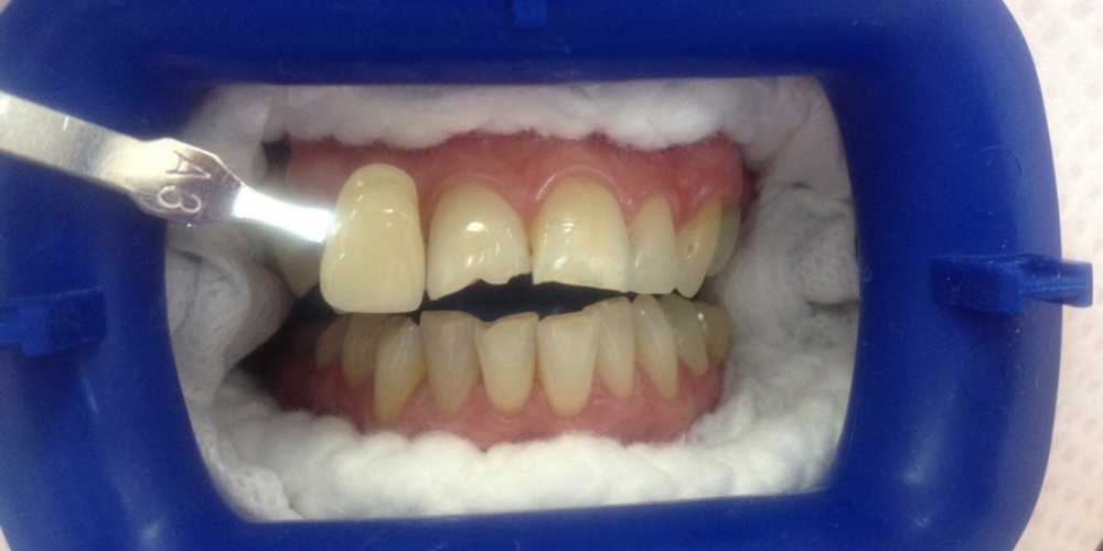 Отбеливание зубов Zoom AP с последующей реставрацией переднего зуба - фото №1