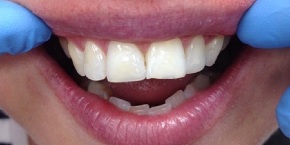 Отбеливание зубов Zoom AP с последующей реставрацией переднего зуба - фото №3