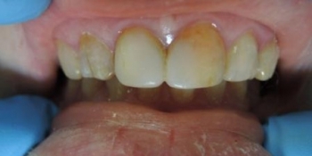 Эстетическая реставрация зубов, поврежденных флюорозом - фото №1
